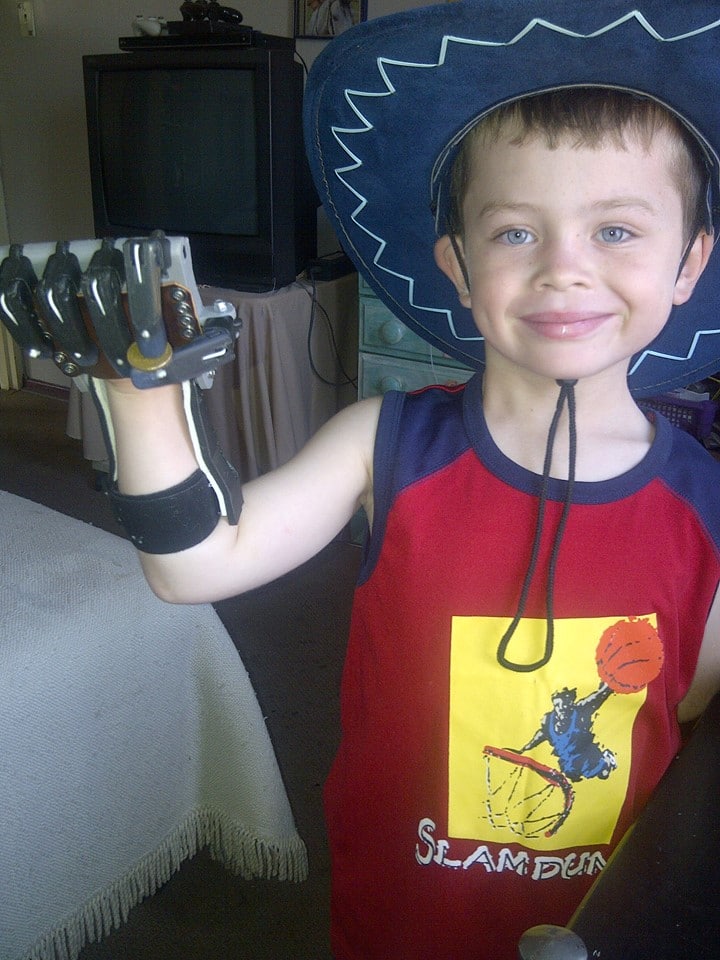 Right handed amputee with a 3D printed prosthetic.