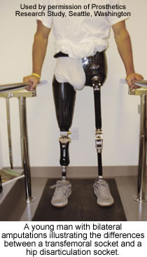 A young man with bilateral amputations illustrating the differences between a transfemoral socket and a hip disarticulation socket.